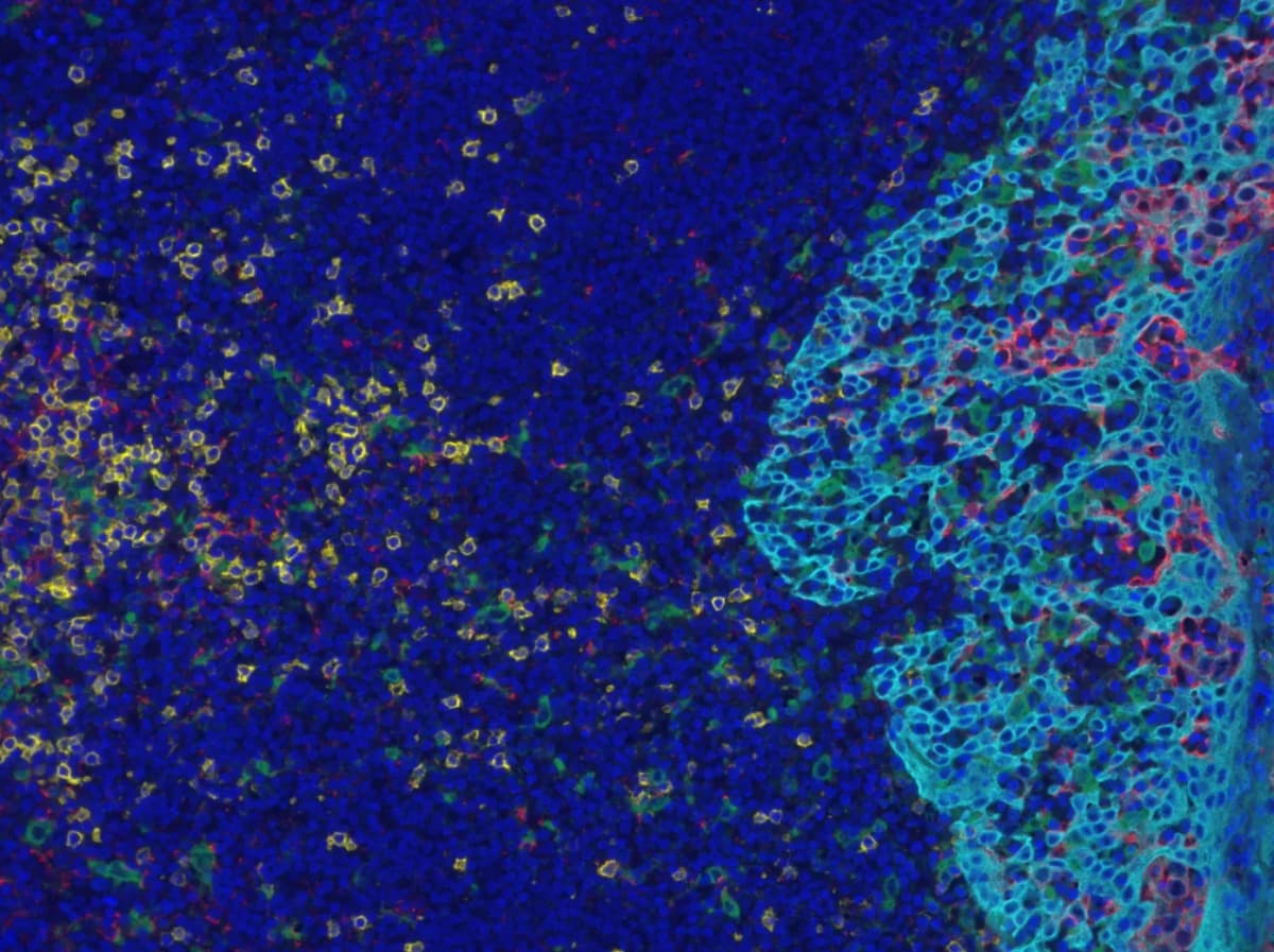 Fluorescence microscopy of immune cell interactions in tumor microenvironment